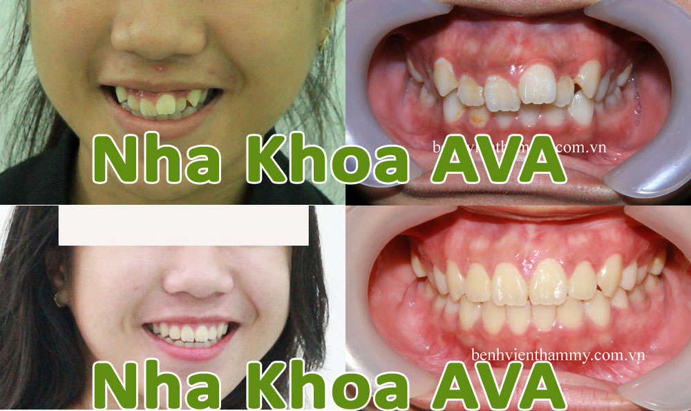 niềng răng niềng răng